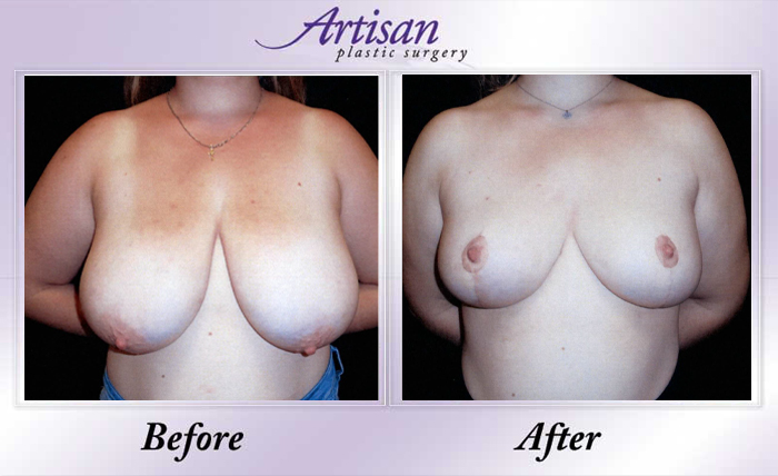 Breast Reduction 11-23