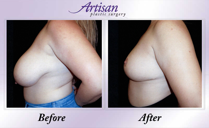 Breast Reduction Side 11-23
