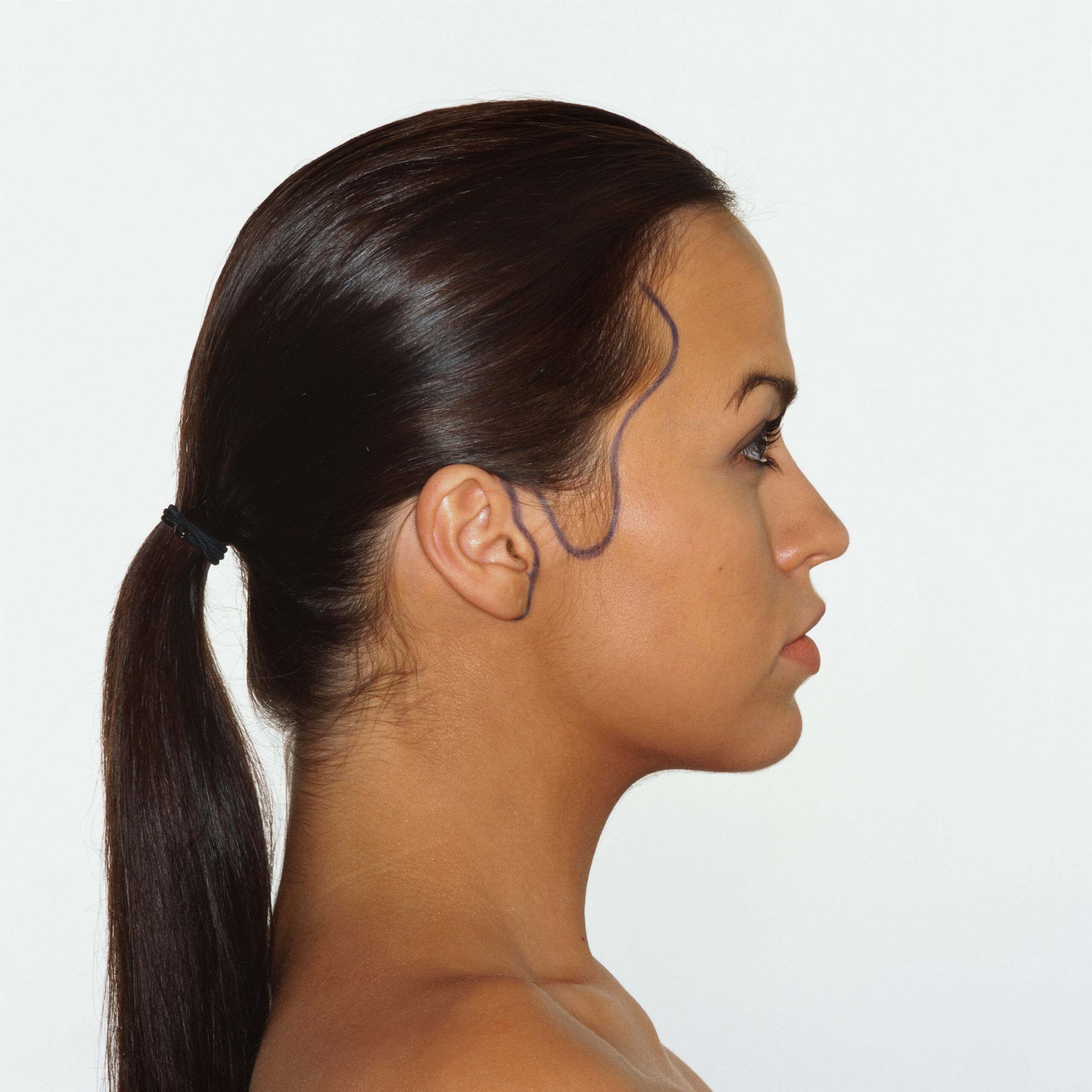 Dr. Francis Johns What Exactly Is a Mini-Facelift?