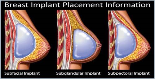 Implant placement diagram