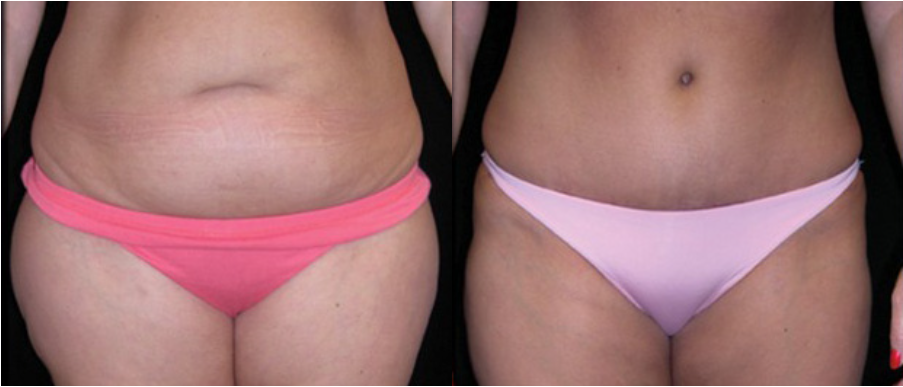 Tummy Tuck actual patient results