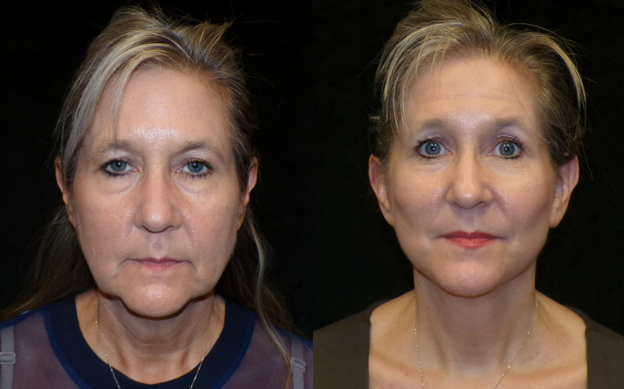 Actual patient results