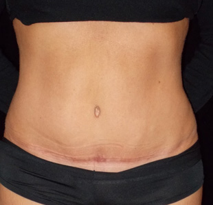 Case--3142 | After Abdominoplasty
