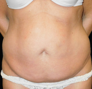 Case--3142 | Before Abdominoplasty