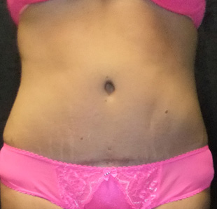 Case--3687 | After Abdominoplasty