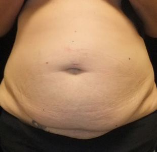 Case--3687 | Before Abdominoplasty