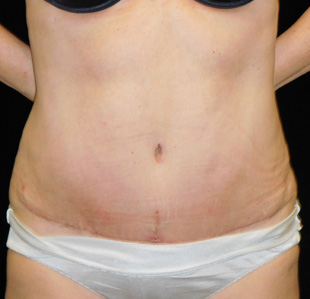 Case--4462 | After Abdominoplasty