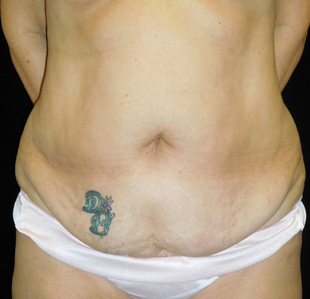 Case--4462 | Before Abdominoplasty