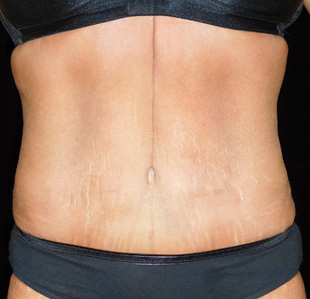 Case--2439 | After Abdominoplasty