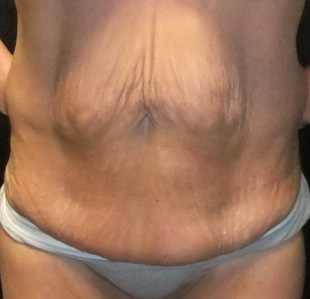 Case--2439 | Before Abdominoplasty