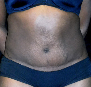 Case--3513 | After Abdominoplasty
