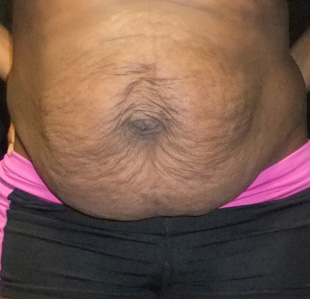 Case--3513 | Before Abdominoplasty