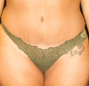 Case--3903 | After Abdominoplasty