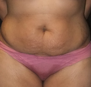 Case--3903 | Before Abdominoplasty