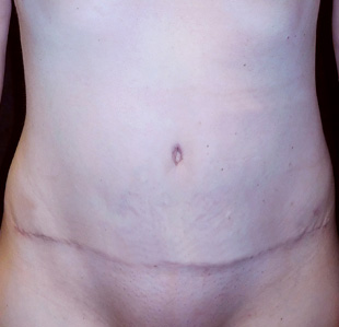 Case--3353 | After Abdominoplasty