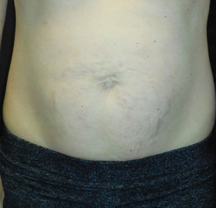 Case--3353 | Before Abdominoplasty