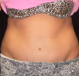 Case--2551 | After Abdominoplasty