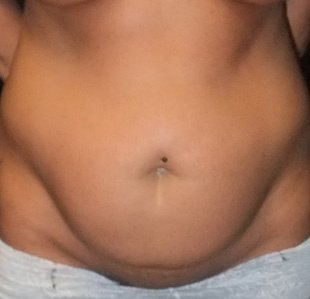 Case--2551 | Before Abdominoplasty