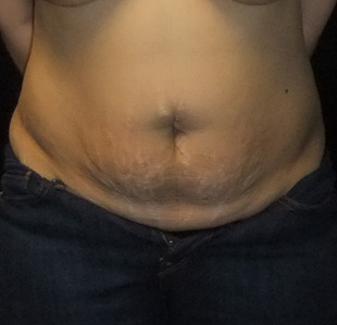 Case--4732 | Before Abdominoplasty