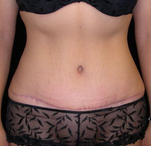 Case--7815 | After Abdominoplasty