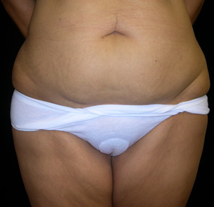 Case--7815 | Before Abdominoplasty
