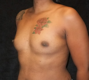 Case--7376 | Before Breast Augmentation