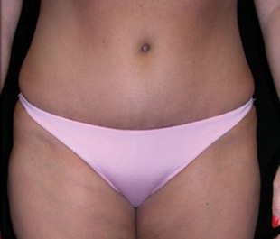 Case--9150 | After Abdominoplasty