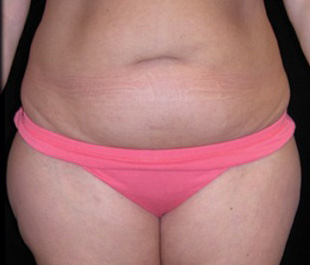 Case--9150 | Before Abdominoplasty