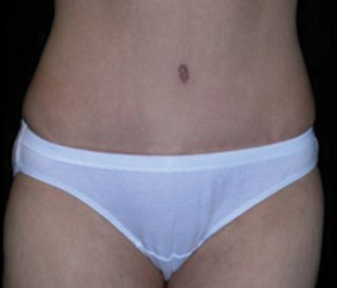 Case--6460 | After Abdominoplasty