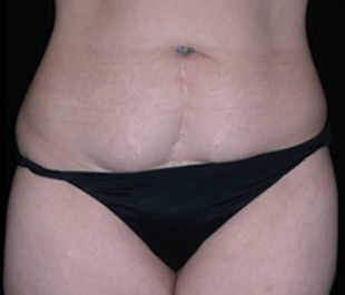 Case--6460 | Before Abdominoplasty