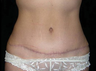 Case--6513 | After Abdominoplasty