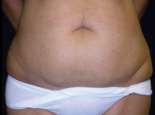 Case--6513 | Before Abdominoplasty