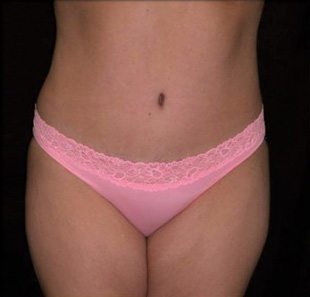 Case--3618 | After Abdominoplasty