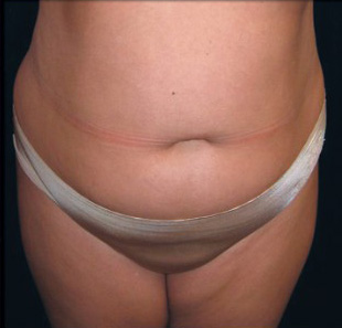 Case--3618 | Before Abdominoplasty
