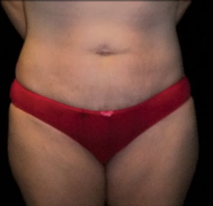 Case--3463 | After Abdominoplasty