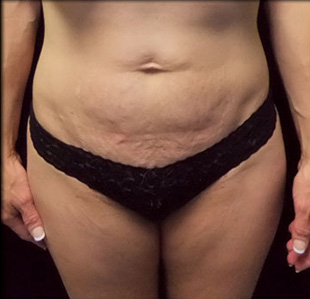 Case--3463 | Before Abdominoplasty