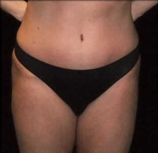 Case--9242 | After Abdominoplasty
