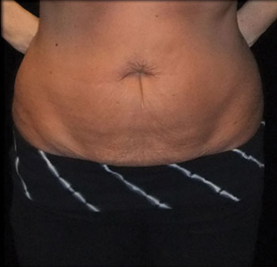 Case--9242 | Before Abdominoplasty