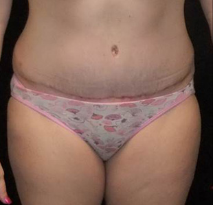 Case--3883 | After Abdominoplasty