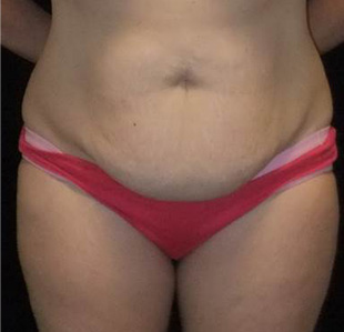 Case--3883 | Before Abdominoplasty