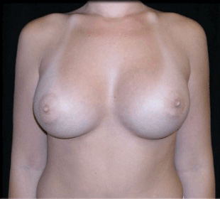 Case--9043 | After Breast Augmentation