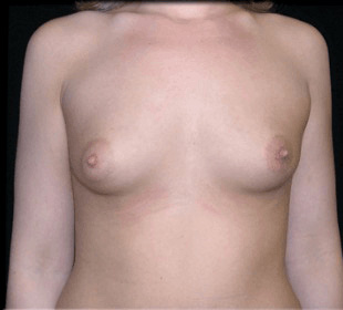 Case--9043 | Before Breast Augmentation