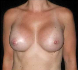 Case--2913 | After Breast Augmentation