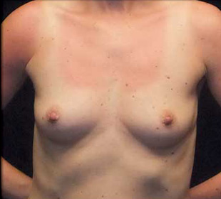 Case--2913 | Before Breast Augmentation