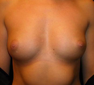 Case--6080 | Before Breast Augmentation