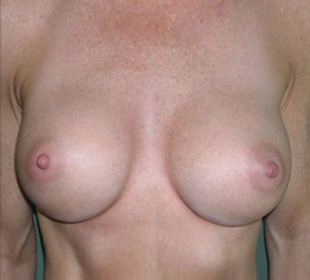 Case--8050 | After Breast Augmentation