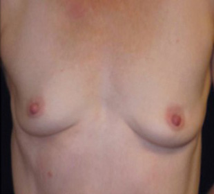 Case--8050 | Before Breast Augmentation
