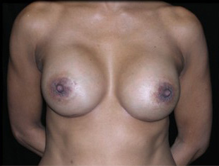Case--3327 | After Breast Augmentation