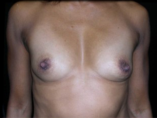 Case--3327 | Before Breast Augmentation
