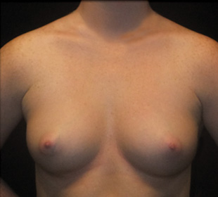 Case--5131 | Before Breast Augmentation
